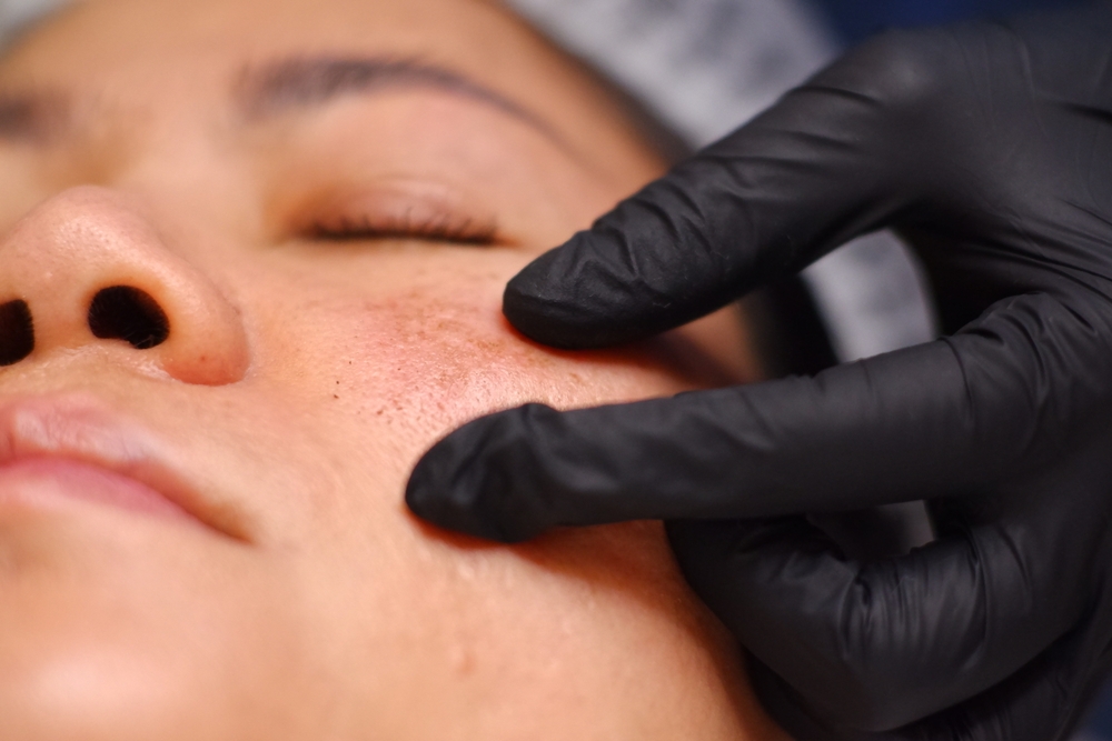 Insights From the Top Melasma Specialists Near Bryn Mawr, PA for Advanced Skin Care