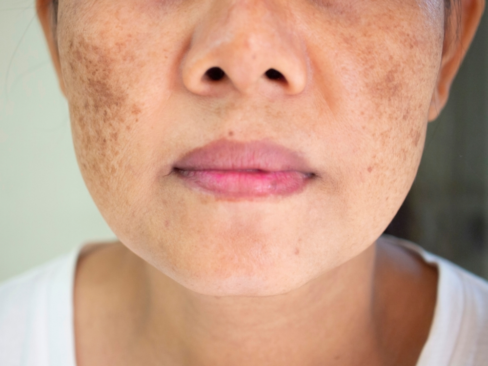 Where to Find the Best Melasma Treatments in Ardmore, Pennsylvania