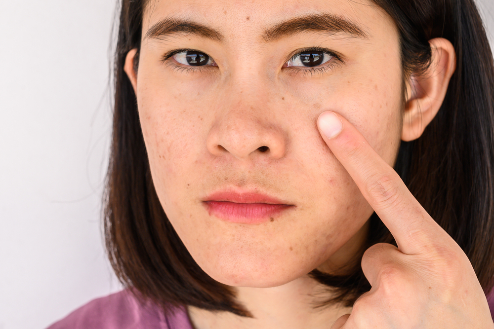 How to Achieve Clearer Skin With a Leading Melasma Doctor in Haverford, PA