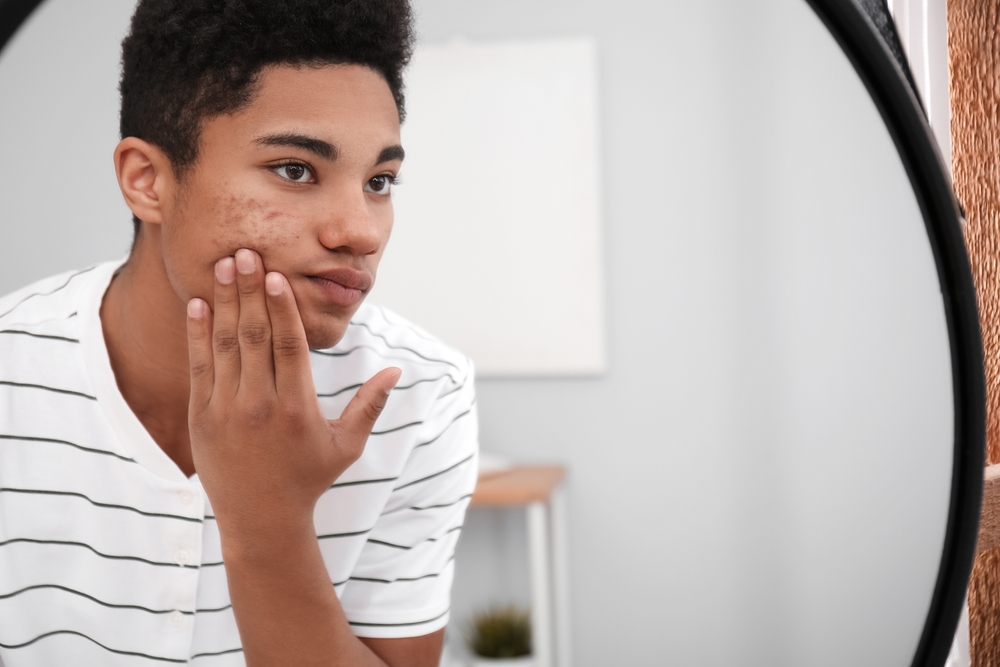 Certified Acne Bootcamp in Philadelphia