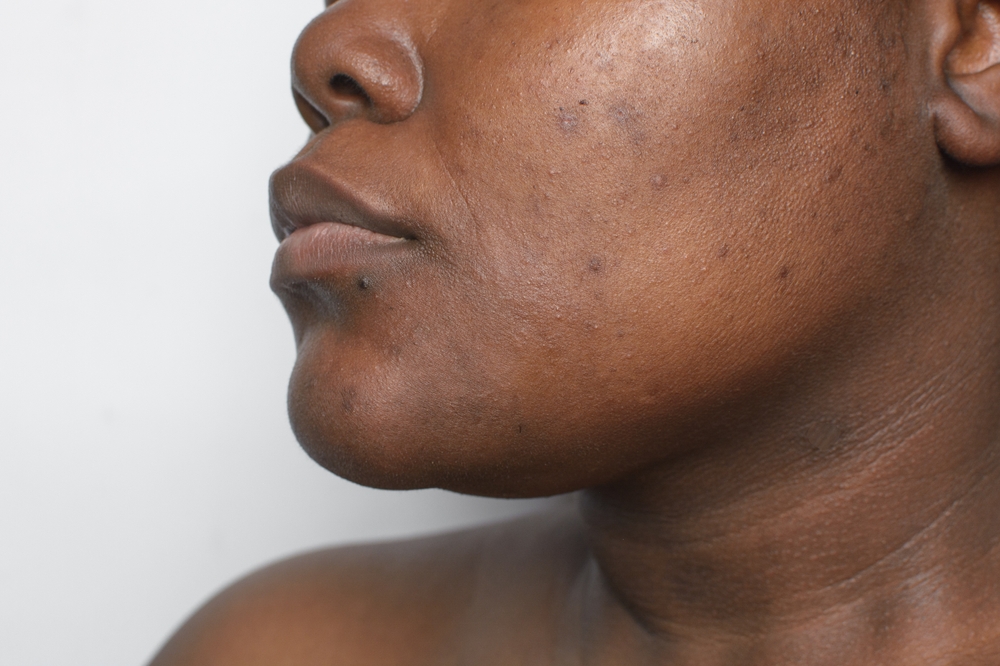 Top Acne Specialists in Northern Liberties: Clear Skin, Local Expertise
