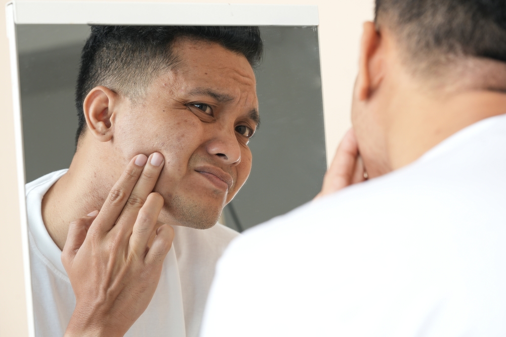 Best Acne Treatment Options in Philadelphia: Clearer Skin Starts Here