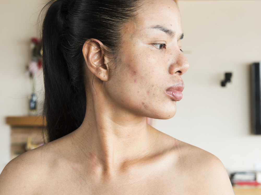 Adult Acne Routine Guide for Philadelphia Professionals