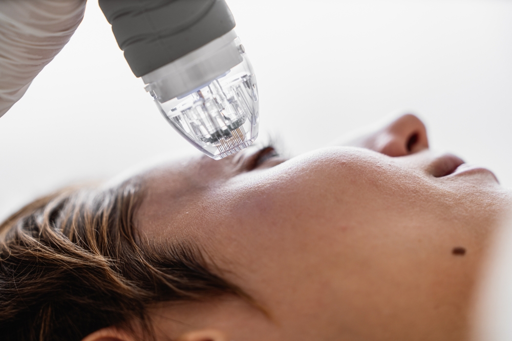 RF Microneedling: Boosting Collagen Production Naturally