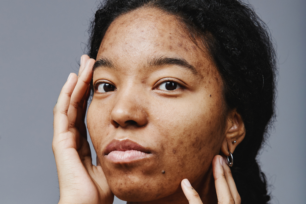 Same-Day Acne Scar and Laser Treatment Consultation in West Philadelphia