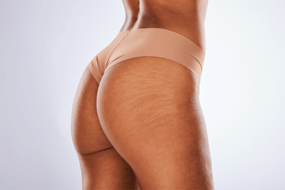 Liposuction in Bryn Mawr Pennsylvania